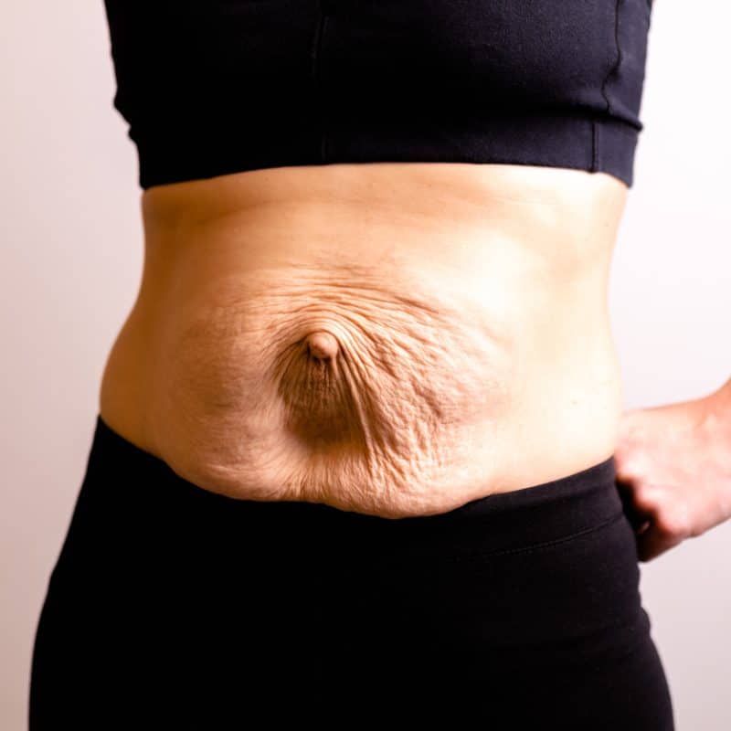 umbilical-hernia-repair-revitalizeinturkey.jpg