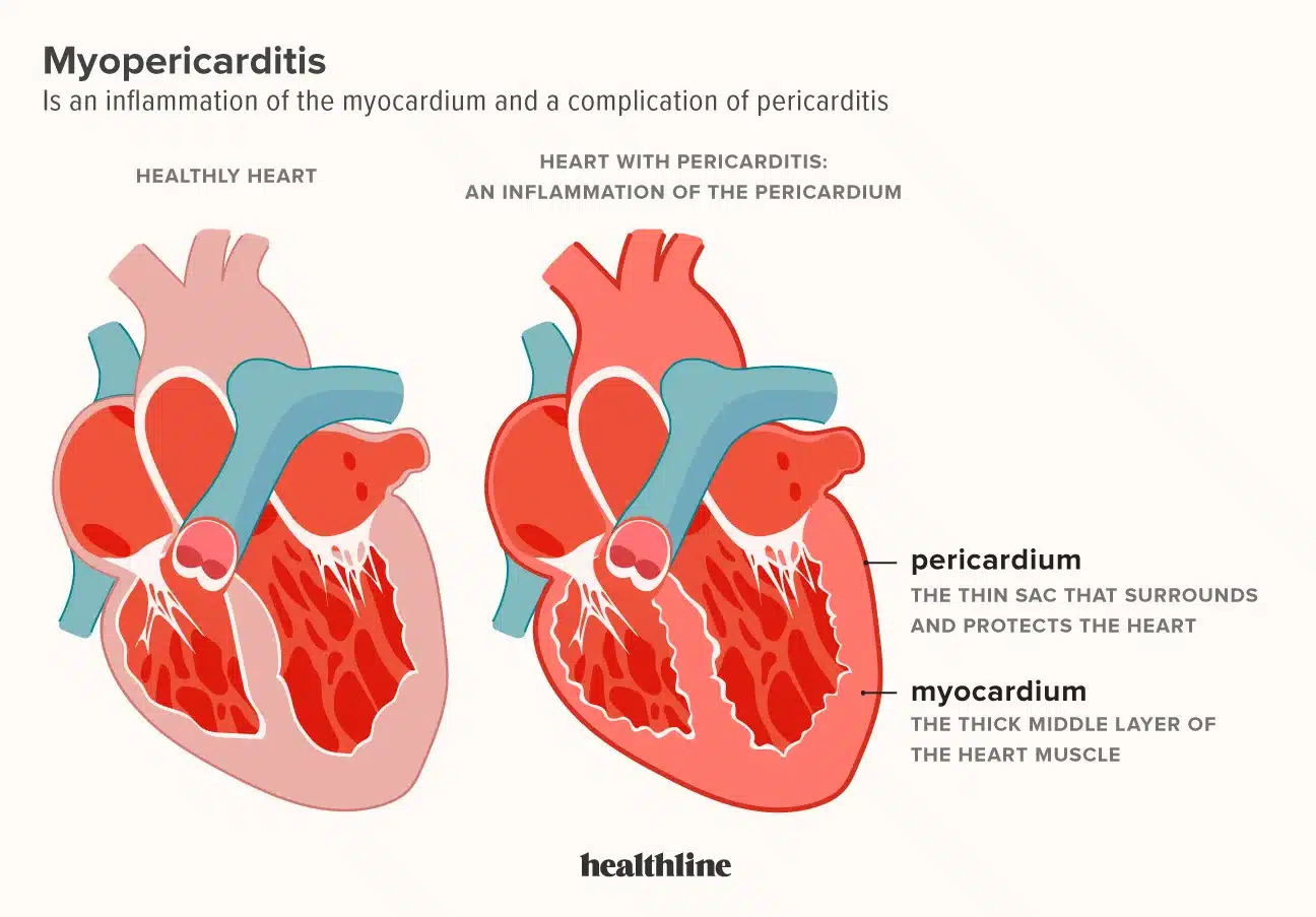 Understanding Pericarditis: Causes & Symptoms