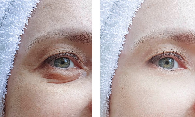 Blepharoplasty Before and After: Transformative Results