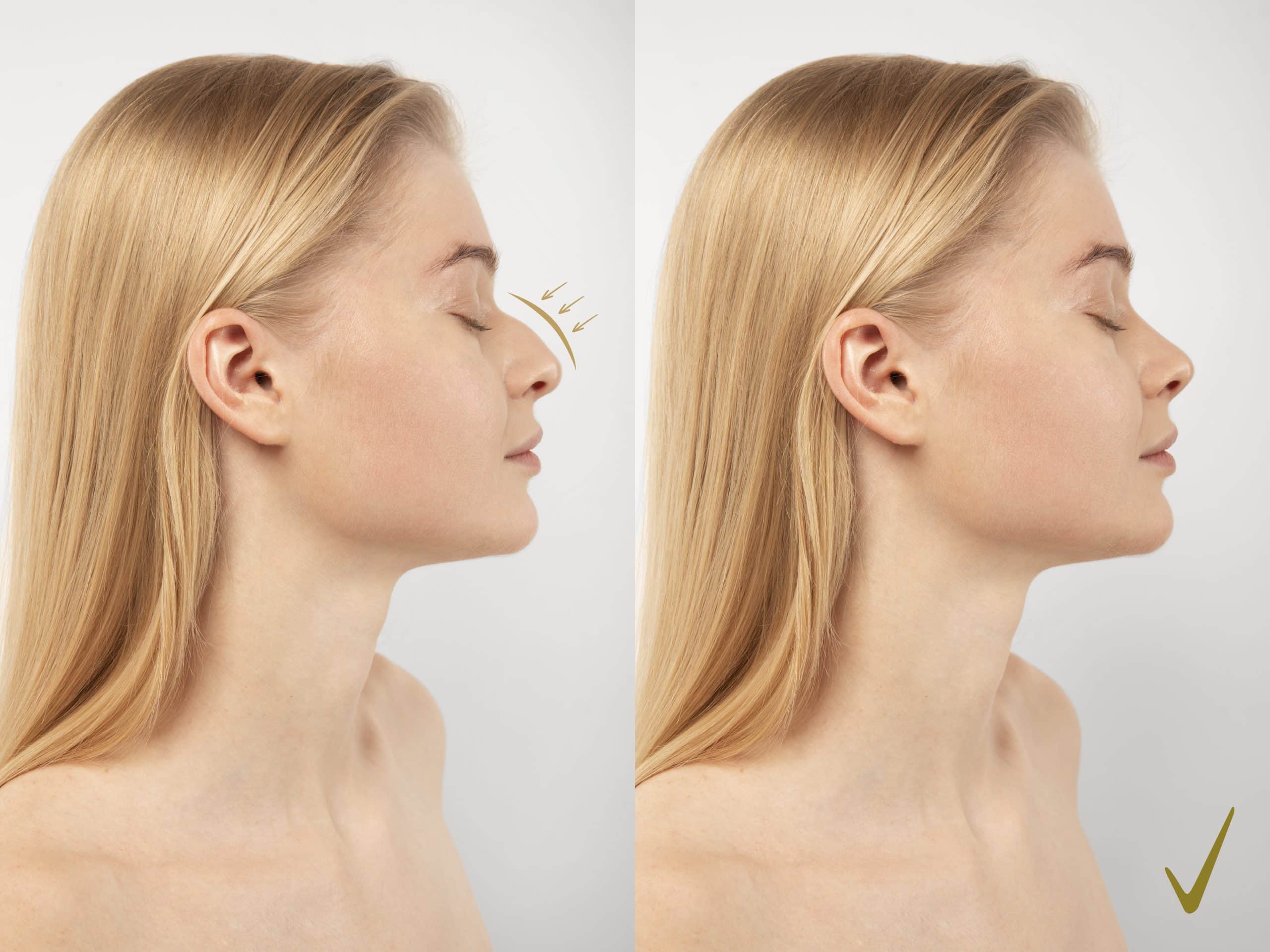 Affordable Rhinoplasty Turkey Cost: Best Prices 2024