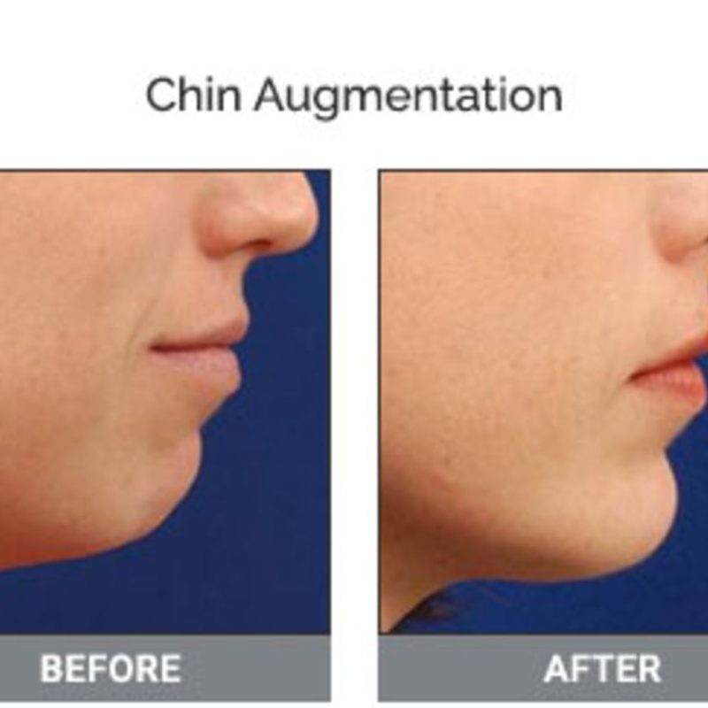 chin-implant-turkey