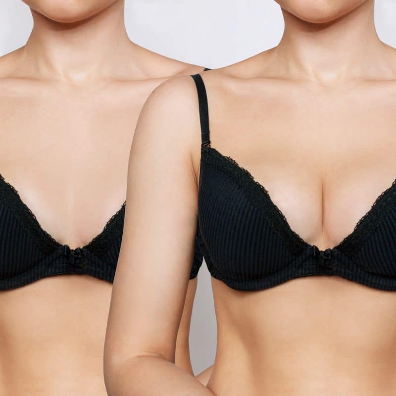 breast enlargement before and after