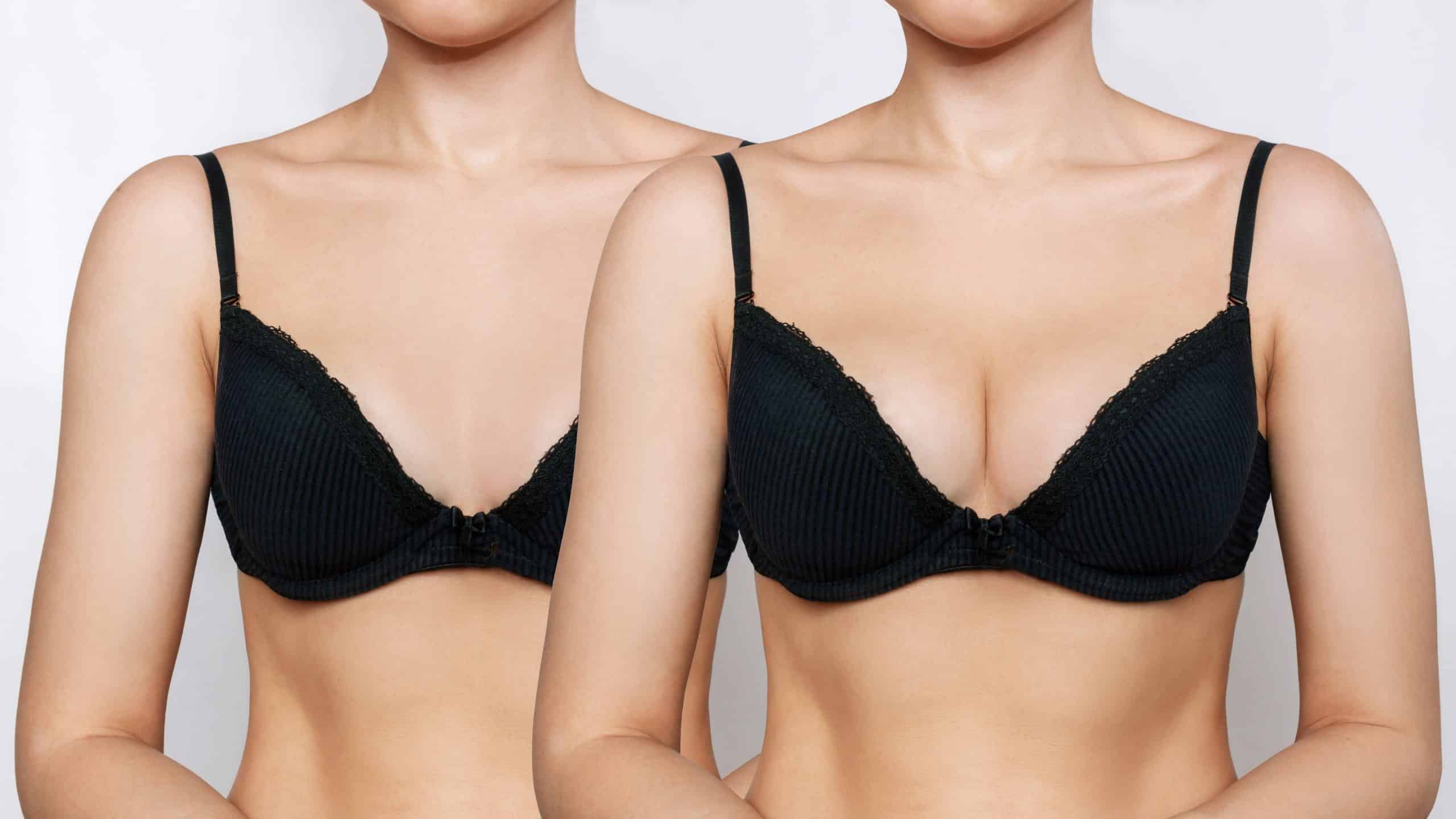 Breast Enlargement Before and After: Real Results