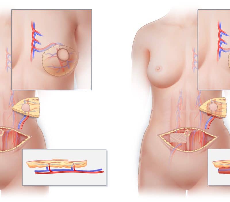 flap-breast-reconstruction