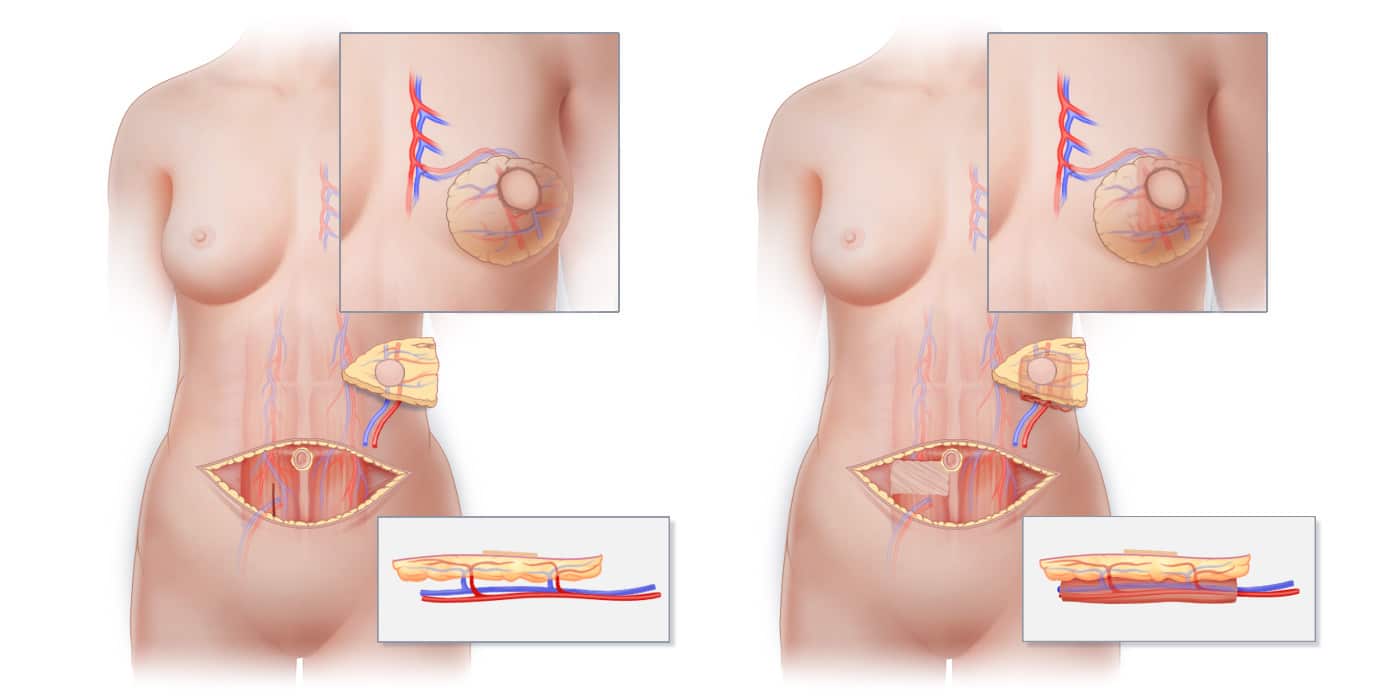 Flap Breast Reconstruction: A Natural Alternative