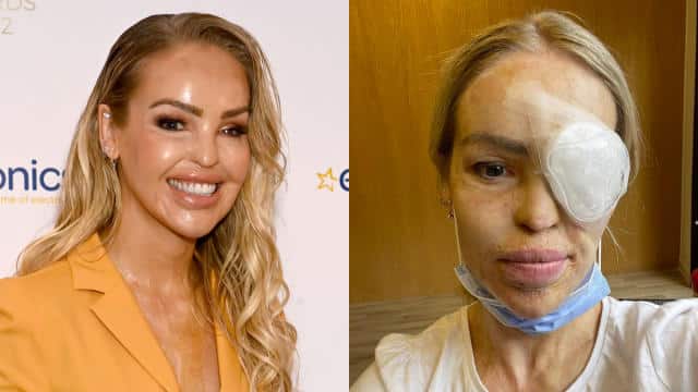 Katie Piper Eye Operation: Recovery and Impact