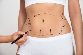 Tumescent Liposuction Turkey: Expert Body Contouring