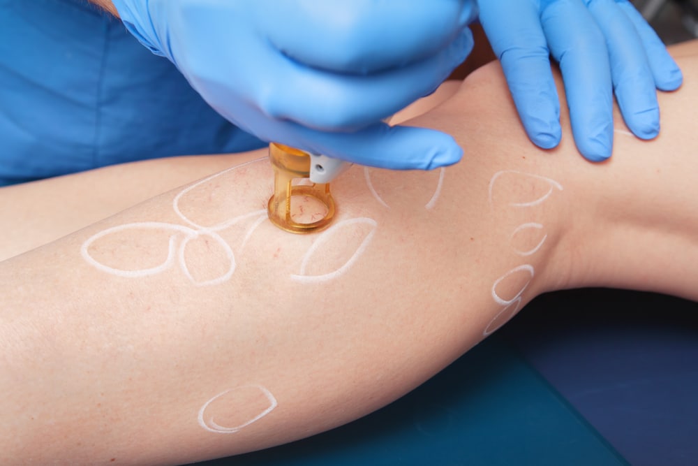 Varicose and Spider Vein Removal: Expert UK Treatment