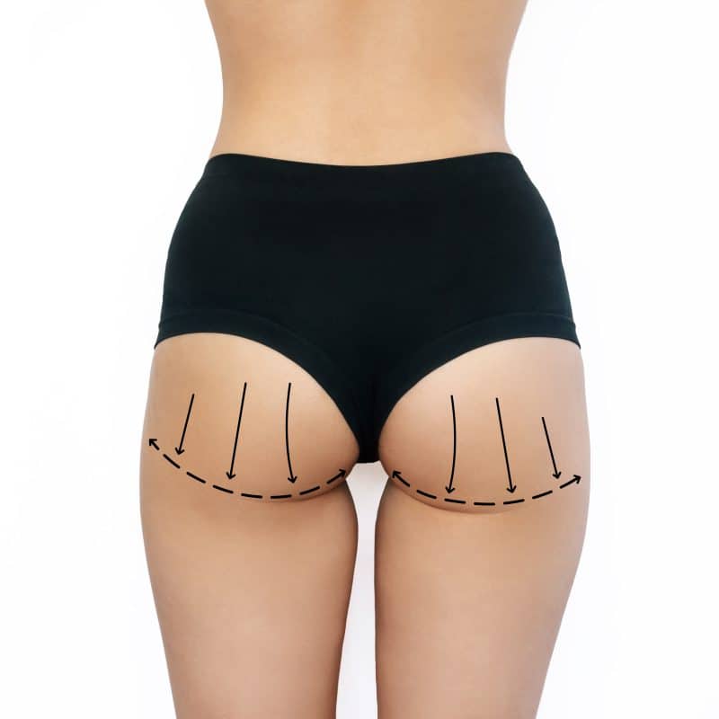 gluteal-enhancement-turkey