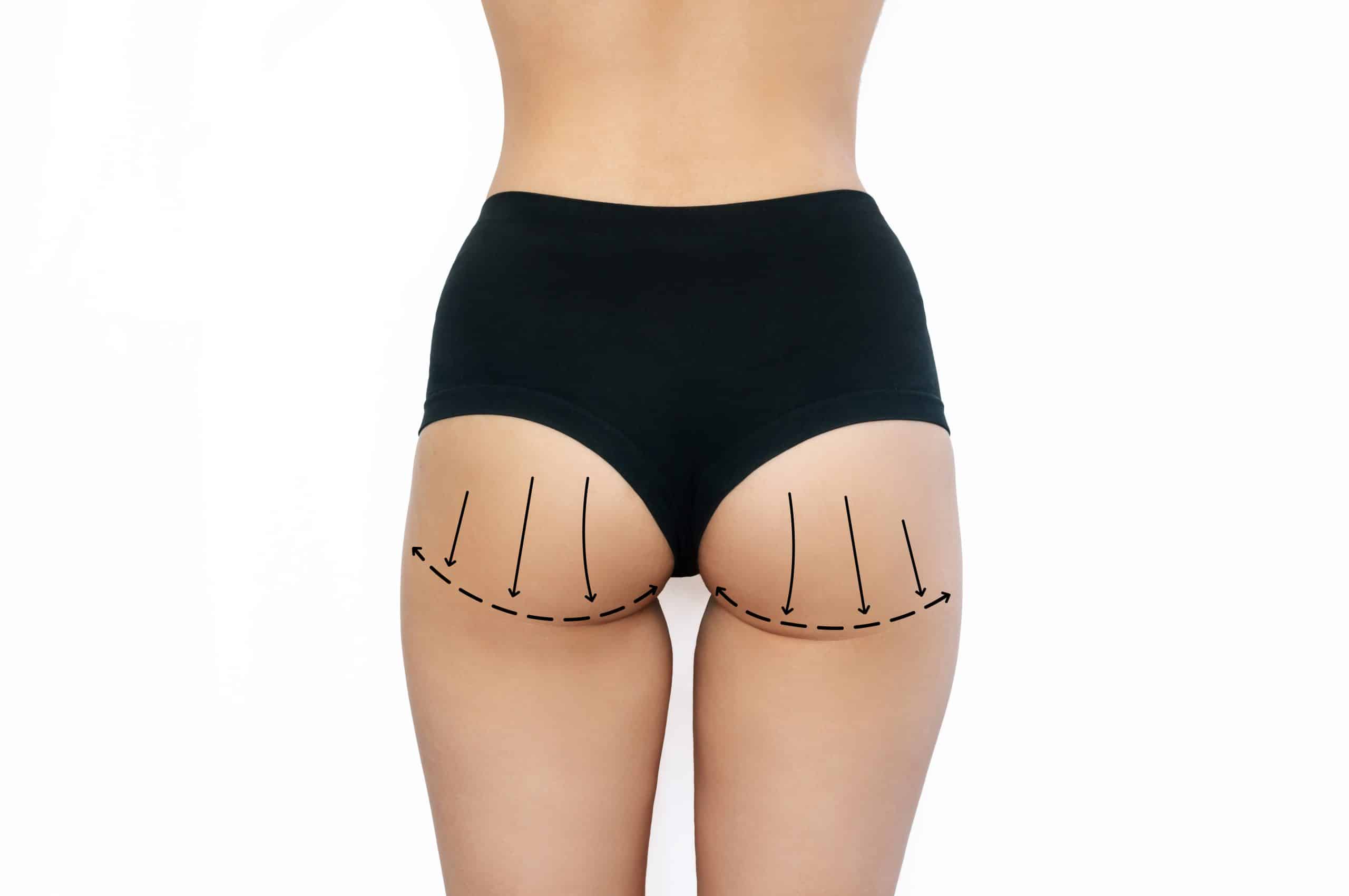 Body ContouringButtock Enhancement in the UK