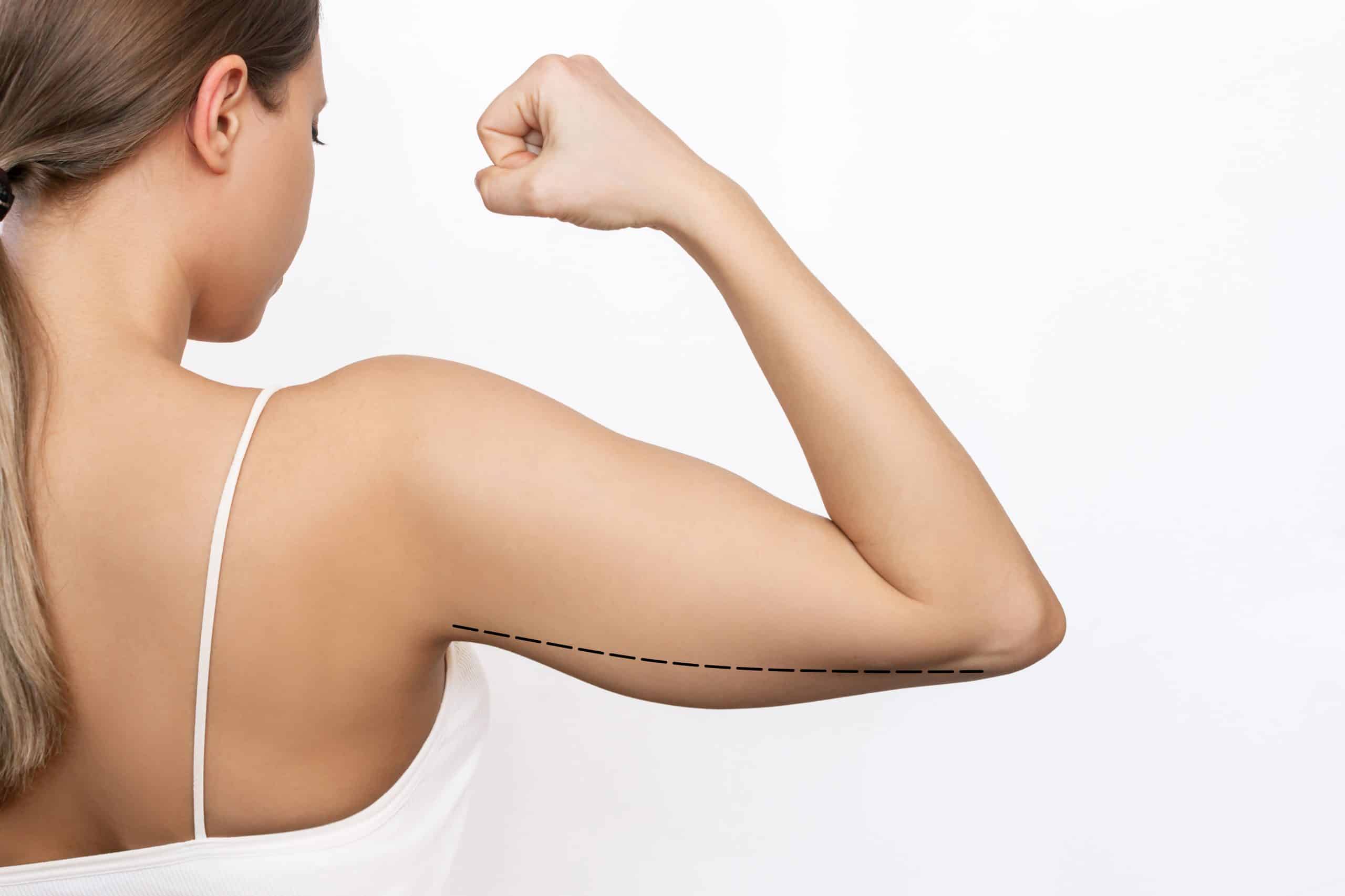 Mini Arm Lift Before and After: Amazing Results Revealed