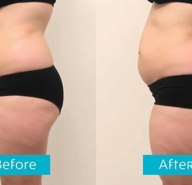 vaser liposuction before and after