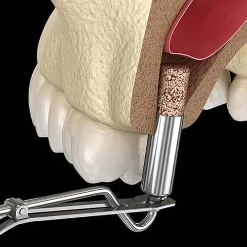 Sinus Lift Surgery