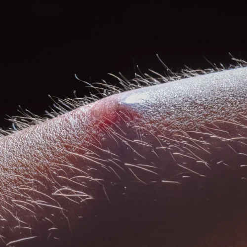 Ingrown Hair Removal Treatment