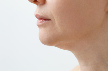 chin liposuction