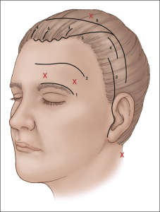 Diagram of brow-lifting incisions.