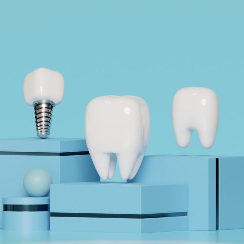 All On Four Implant Treatment