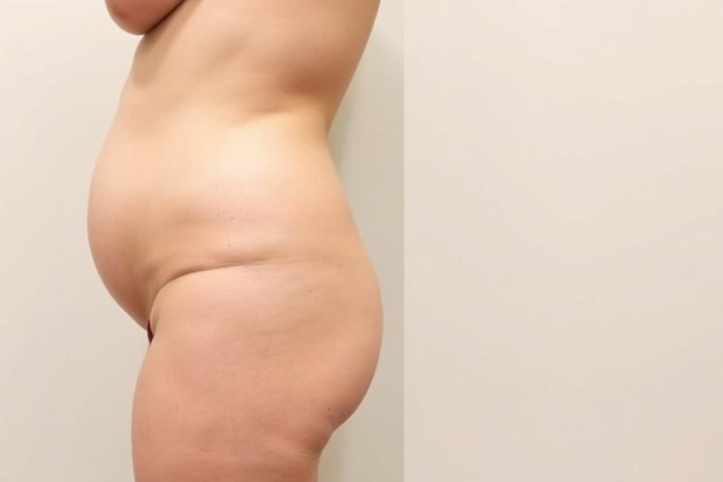 Ideal tummy tuck candidate showing excess abdominal skin