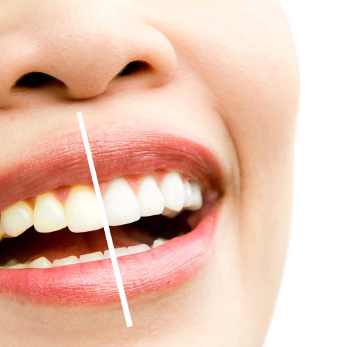 All Ceramic Dental Crowns – Eco Package