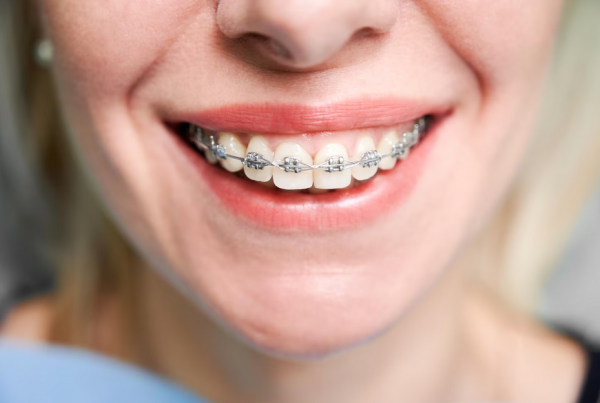 Dental Braces