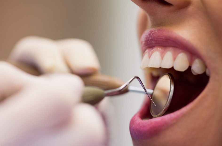 oral cyst removal