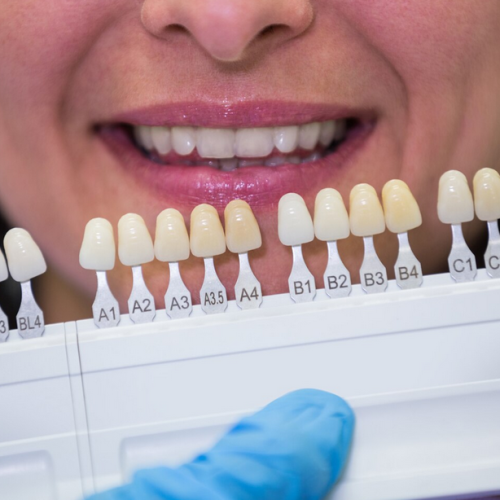 Emax Crowns