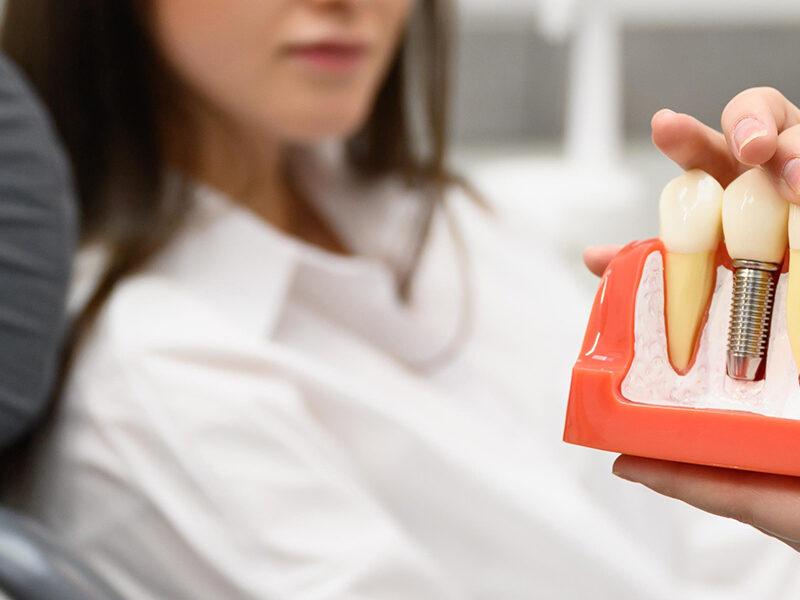 upper jaw dental implants