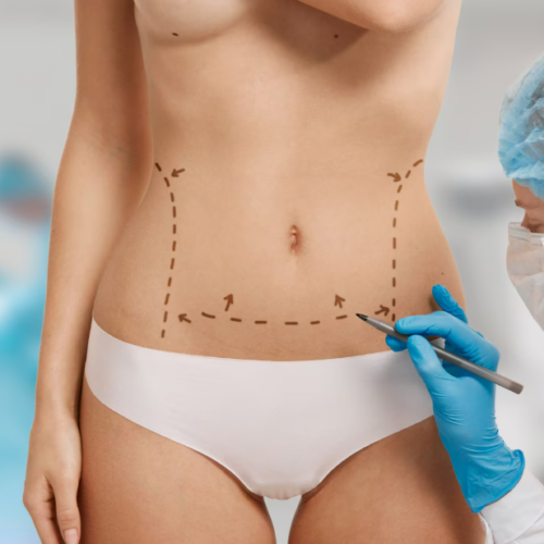 vaser liposuction