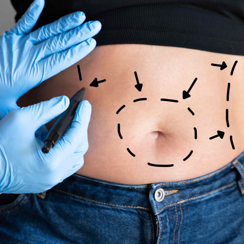 liposuction