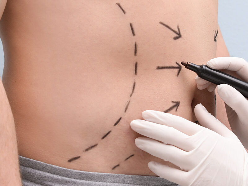 male liposuction
