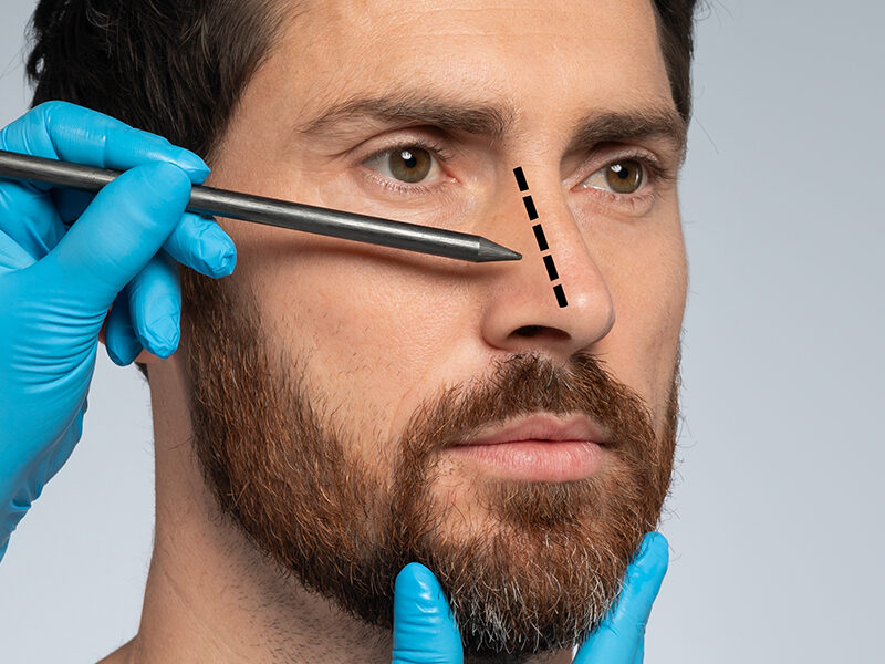 revision rhinoplasty