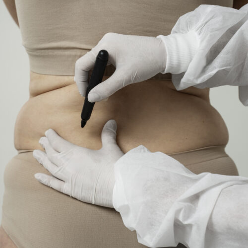 Liposuction