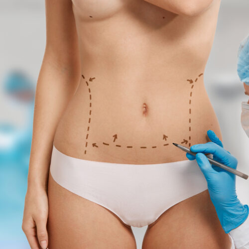 Standard Mommy Makeover Package