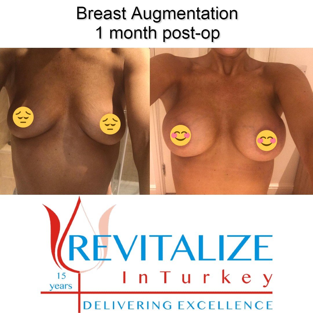 Breast augmentation before surgery and 1 month after surgery