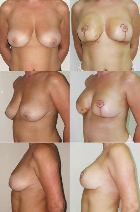 Front, oblique and side views before and after breast uplift