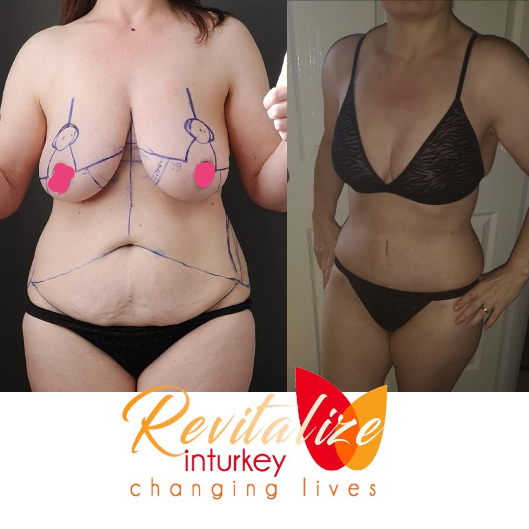 Before breast uplift, tummy tuck and liposuction and 6 weeks after surgery