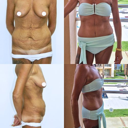 tummy tuck before &amp; after