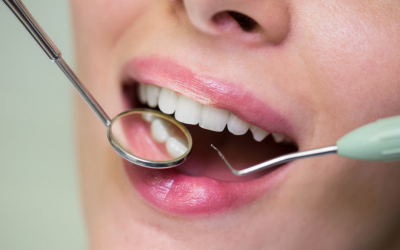 full mouth dental makeover