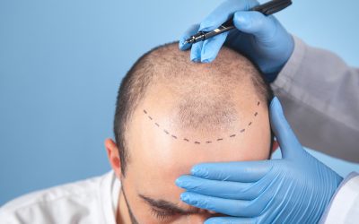 Hair Transplant with FUE Technique 2