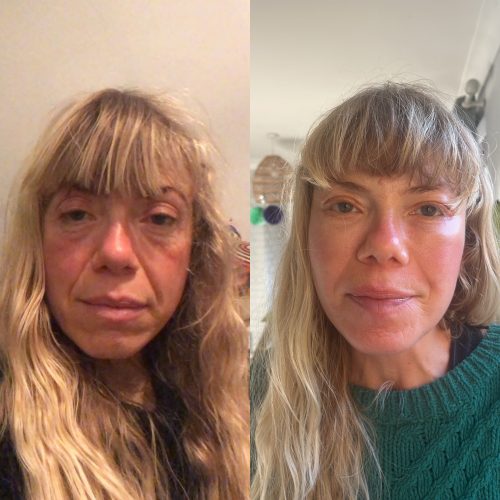 Deep plane facelift before after
