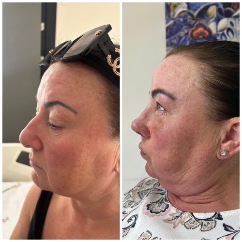 rhinoplasty before &amp; after