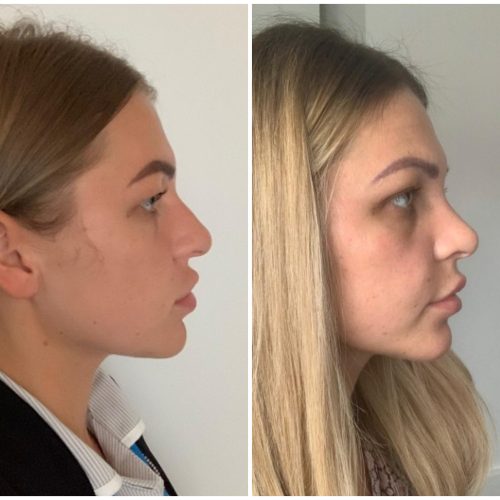Rhinoplasty before after