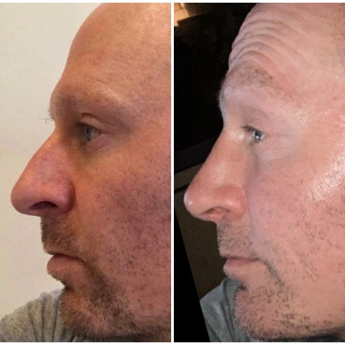Rhinoplasty before after