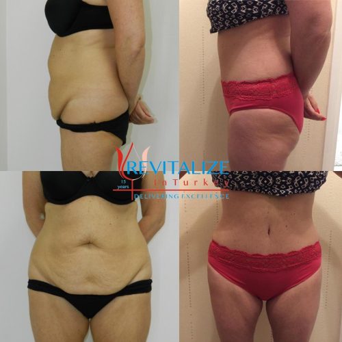 tummy tuck and liposuction before &amp; after