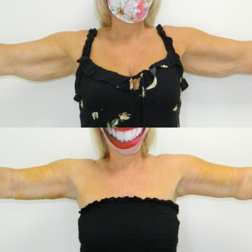 arm lift before after