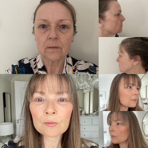 Deep plane facelift before after
