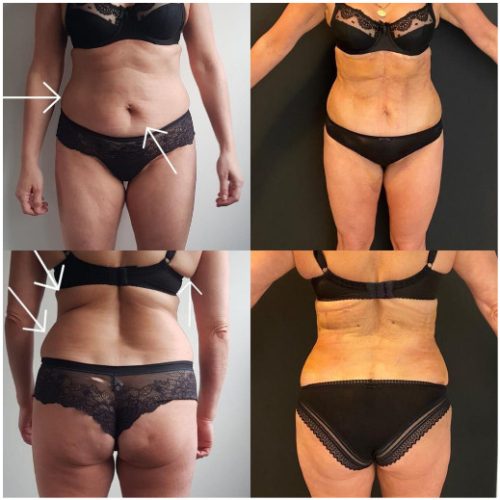 Liposuction before & after