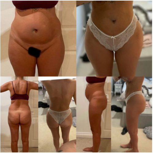 Liposuction before & after