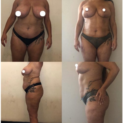 Vaser liposuction before & after