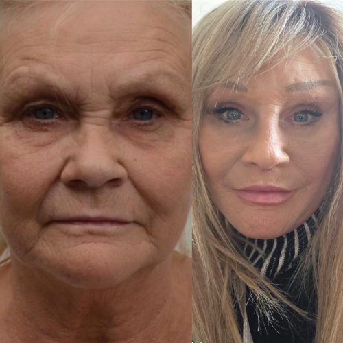 smas facelift before after